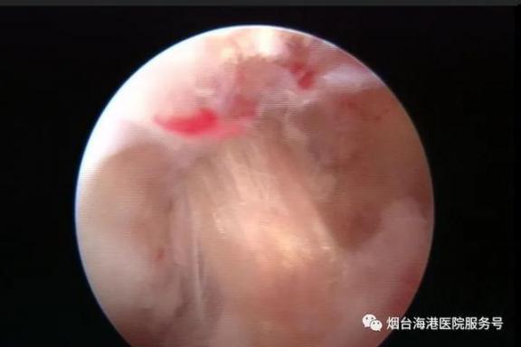 学科力量丨骨关节微创治疗之关节镜技术  骨关节炎的病因 骨与关节结核 团结就是力量串词 微创治疗 痔疮患者应注意什么 第5张