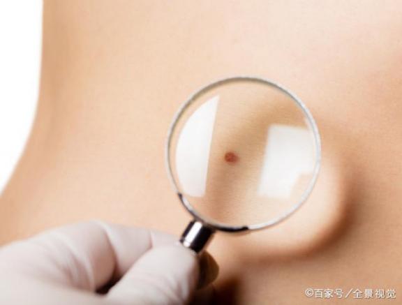 身上不起眼的痣，有4种或是瘤的“先行官”，建议别无视  黑色素瘤治疗方法 治疗脚气脚臭的方法 合肥治疗皮肤病 cf无视者 身体美白产品 其实你不用去远方 环境建议书 对学校工作的建议 dnf被无视的可怜人 皮肤黑的人穿什么颜色好看 第3张