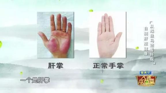 肝有“3怕”，沾上一个，离肝炎、肝硬化、肝癌，更进一步！  介入治疗肝癌 肝癌治疗药物 男性肝癌的早期症状 一包食材 治疗甲型肝炎 葛根粉丰胸有效果吗 葛根素片 葛根粉什么时候吃 肝脏血管瘤症状 早期肝硬化治疗 第5张