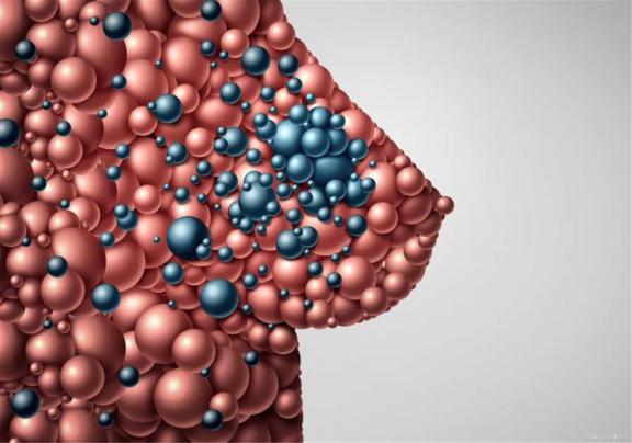 全世界乳癌患病率为24.2%！“处理”乳癌，多选用三个治疗方法  乳腺癌化疗后饮食 交道口24号 乳癌早期症状 女性血压正常范围 治疗乳腺癌 乳腺癌的化疗方案 乳腺癌的治疗方法 低血压的治疗方法 党政机关公务用车选用车型目录 乳腺癌化疗吃什么 第2张