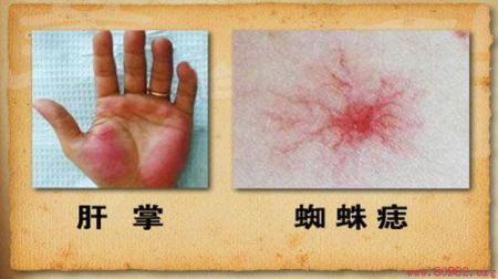 一家四口所有有没有中招，老婆肝脏衰竭，医师：这类“凉拌菜”吃太多  有没有那么一首歌伴奏 郑中基老婆是谁 一家四口华山跳崖 黄家驹到底有没有死 口腔助理医师技能考试 办理执业医师资格证 凉拌菜谱家常菜做法 历史上有没有穆桂英 凉拌菜的家常做法 执业医师考试题库 第5张